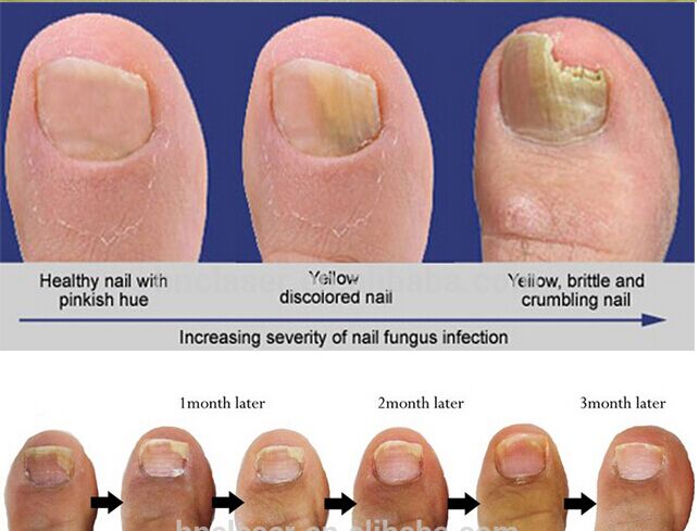 The latest Nail Fungus laser treatment